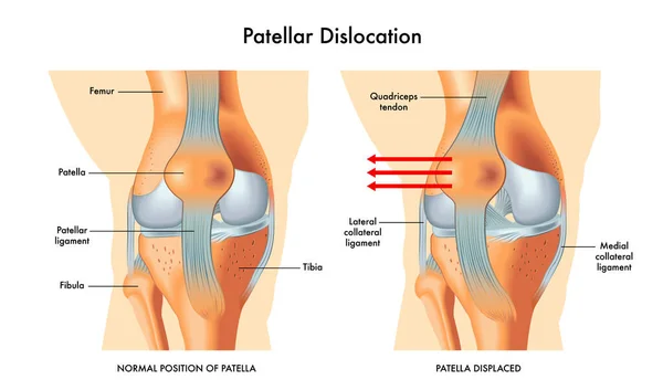 Gambar Vektor Dislokasi Patellar - Stok Vektor