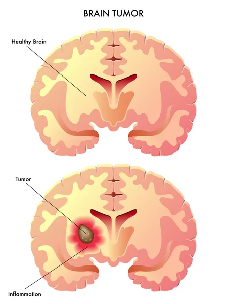 Diversi tipi di tumori cerebrali . — Vettoriale Stock