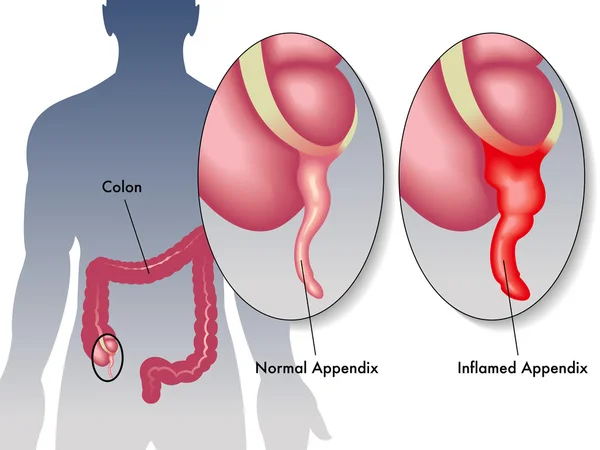 Detalle de una apendicitis — Vector de stock