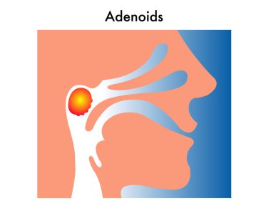 Adenoids clipart