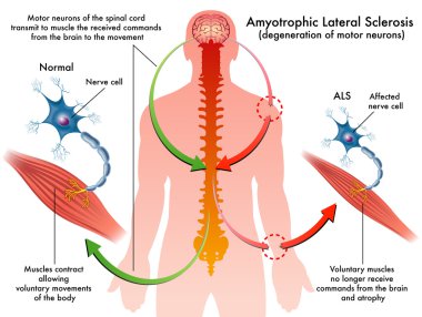 ALS (amyotrophic lateral sclerosis) clipart