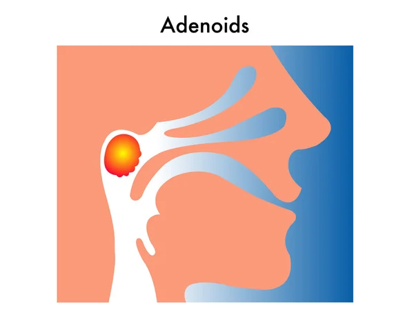 Adenoides — Vector de stock