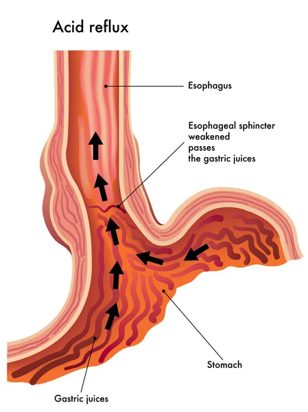 Kyselý reflux — Stockový vektor