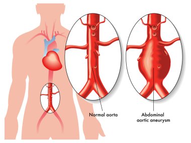Abdominal aort anevrizması