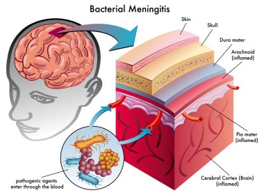 Bacterial Meningitis clipart