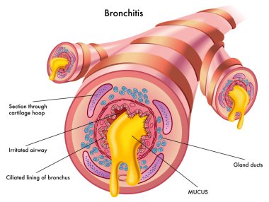 Bronşit
