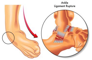 Ankle ligament rupture clipart
