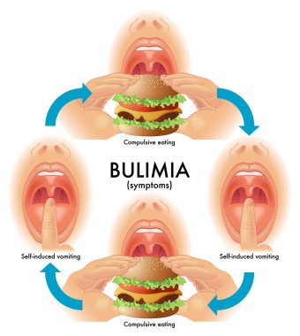 Bulimia