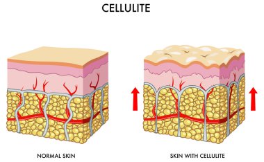 Skin cross section showing cellulite clipart