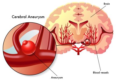 Cerebral aneurysm clipart