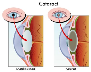 Katarakt