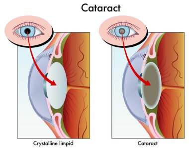 Cataract clipart