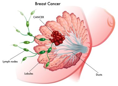 Göğüs kanseri