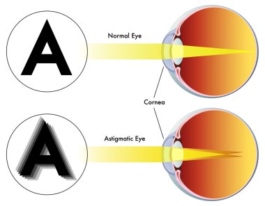 Astigmat