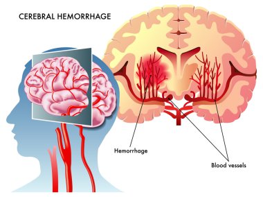 Cerebral Hemorrhage clipart