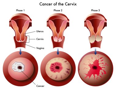 Cervical cancer clipart