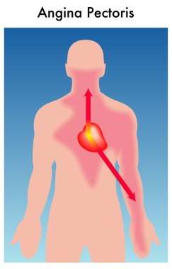 angina pektoris.
