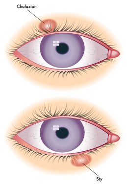 Chalazion ve arpacık