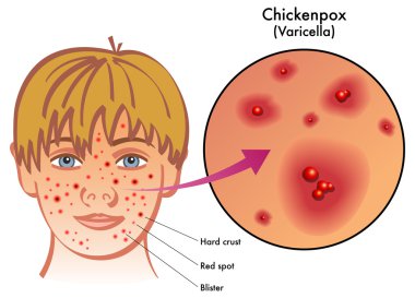 Chickenpox clipart