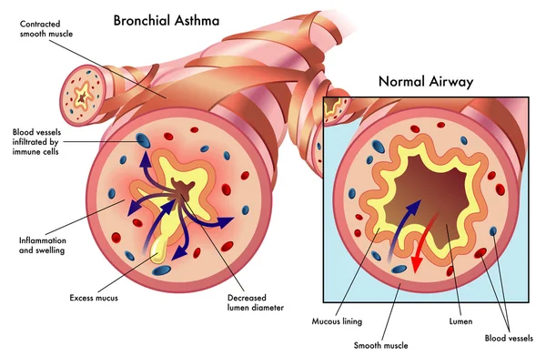 Asthme bronchique — Image vectorielle