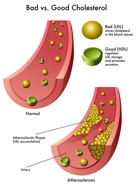 Cholesterol — Stockový vektor