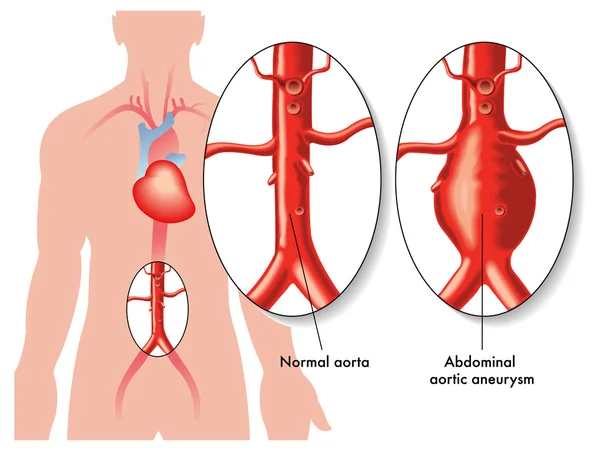 Abdominales Aortenaneurysma — Stockvektor