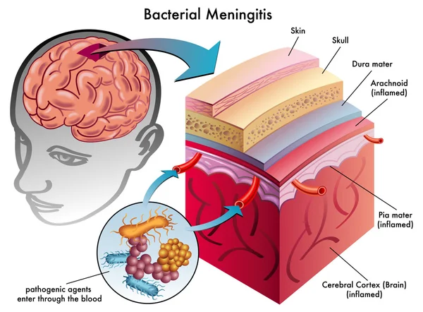 Meningitis bacteriana — Archivo Imágenes Vectoriales