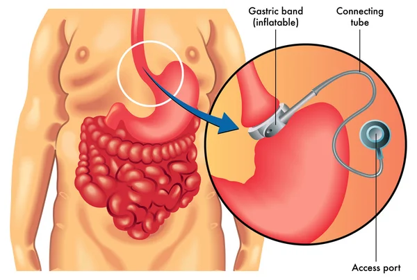 Bandage gastrique réglable — Image vectorielle