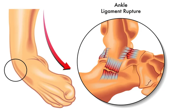 Ruptura do ligamento do tornozelo — Vetor de Stock