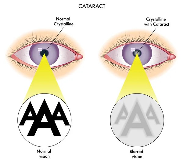 Cataract — Stockvector