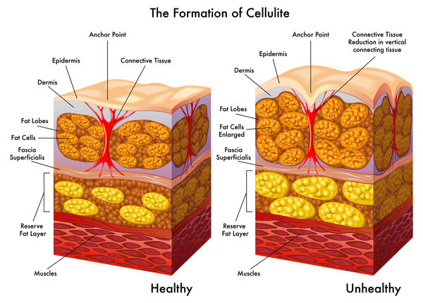 Skin cross section showing cellulite
