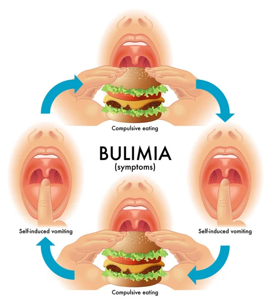 Bulimia — Vector de stock