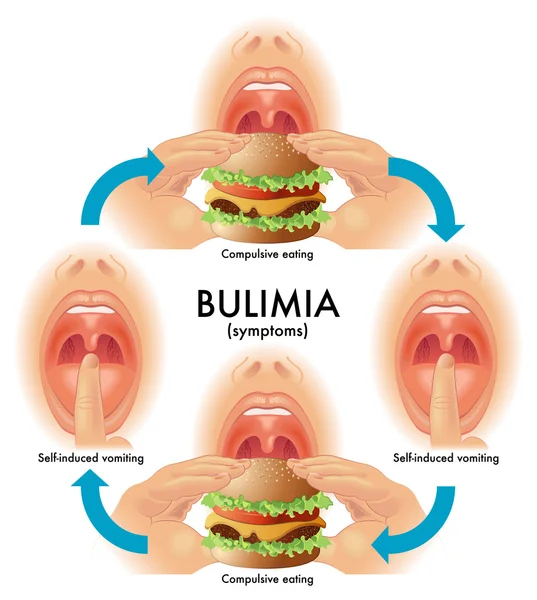 Булімія — стоковий вектор