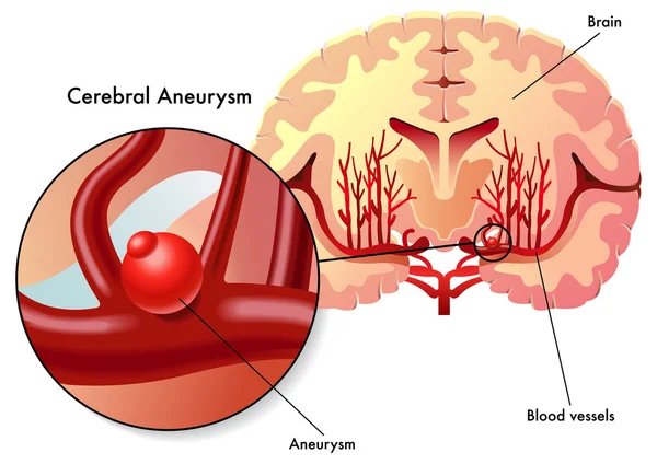 Aneurisma cerebral — Archivo Imágenes Vectoriales