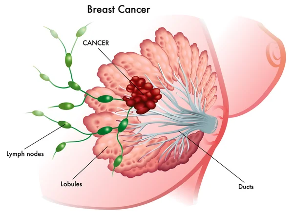 乳腺癌： — 图库矢量图片