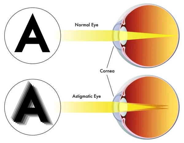 Astigmatismo — Archivo Imágenes Vectoriales