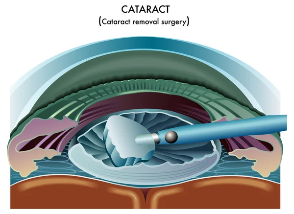 Cataracte — Image vectorielle