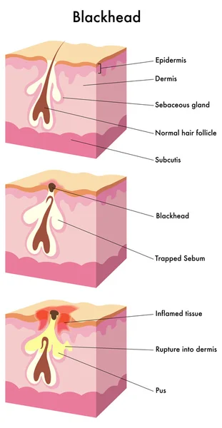 Blackhead — Stock Vector