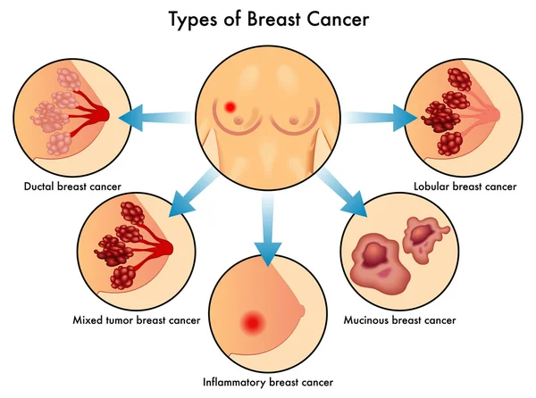 Tipos de cáncer de mama — Vector de stock