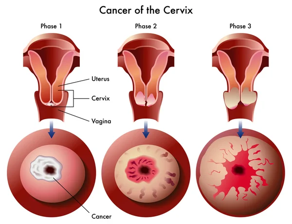 Cáncer cervical — Vector de stock