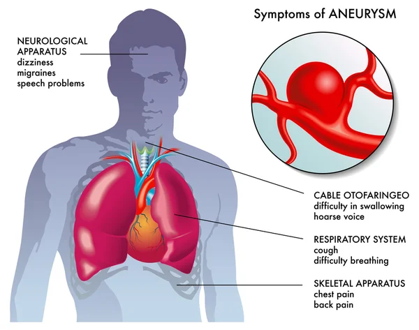 Aneurysma příznaky — Stockový vektor