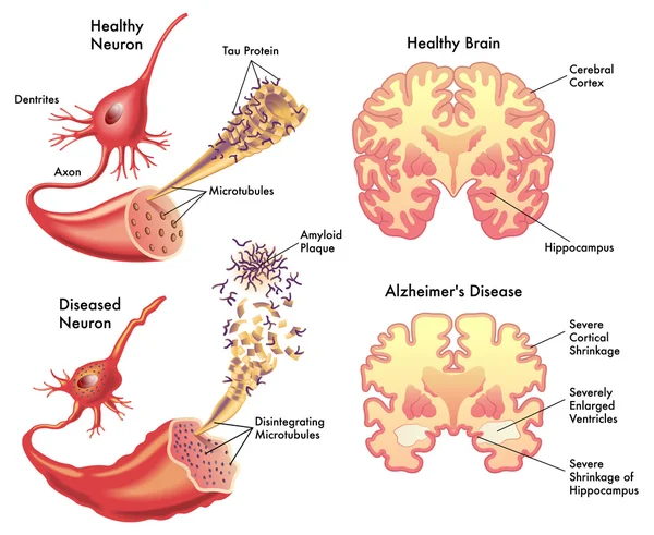 Alzheimer — Archivo Imágenes Vectoriales