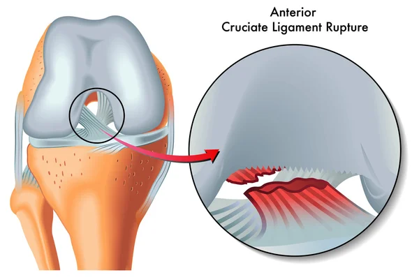 Anterior cruciate rupture — Stock Vector