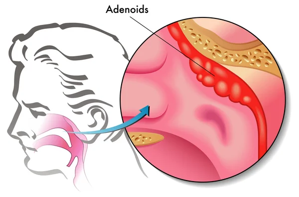 Adenoide — Stockvektor