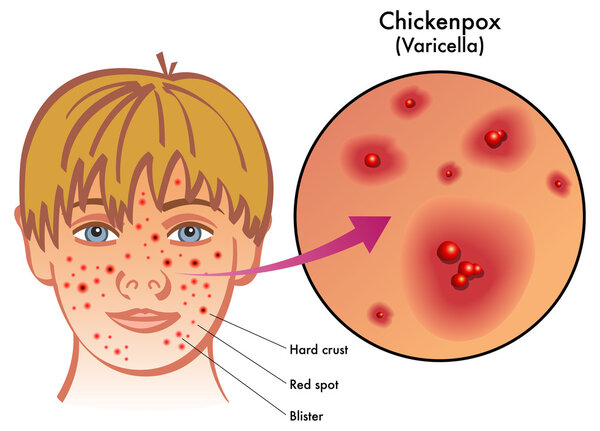 Chickenpox