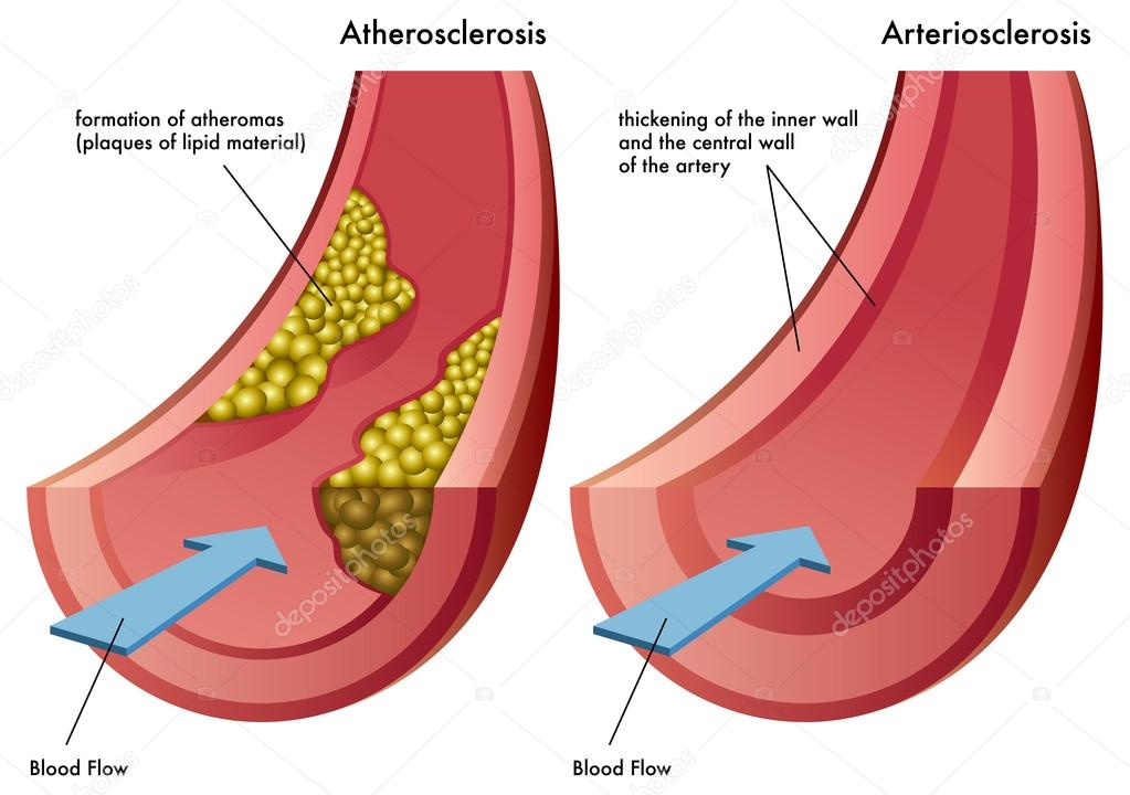 Process of ateriosclerosis