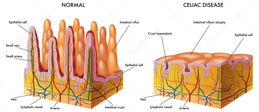 Celiac disease