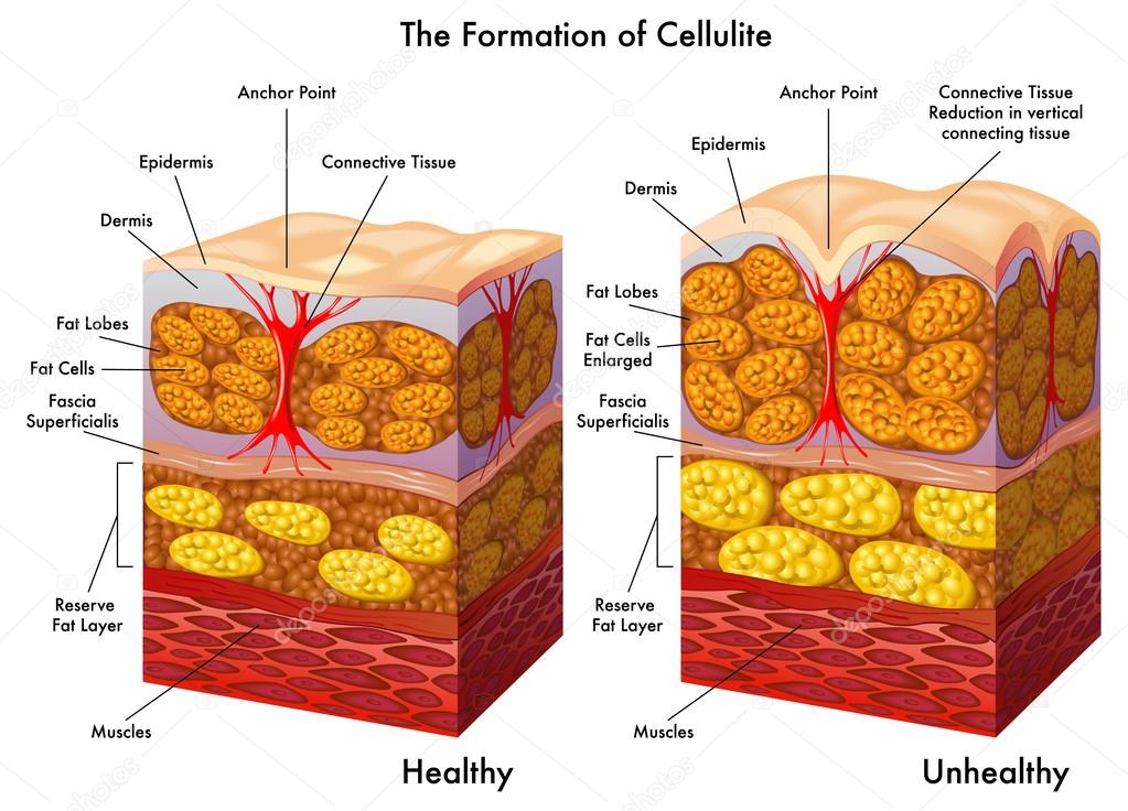 Skin cross section showing cellulite