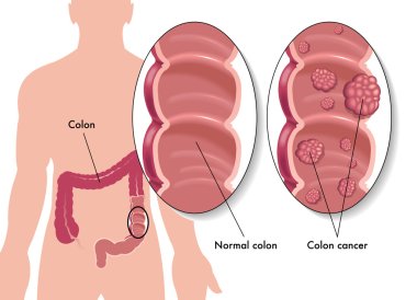 Colon cancer clipart