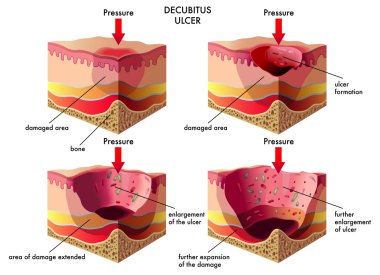 Decubitus Ülseri